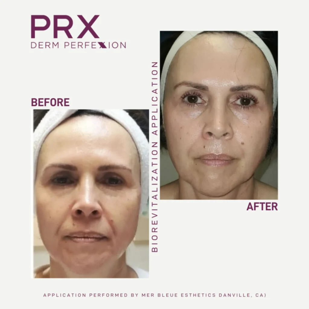 PRX Derm