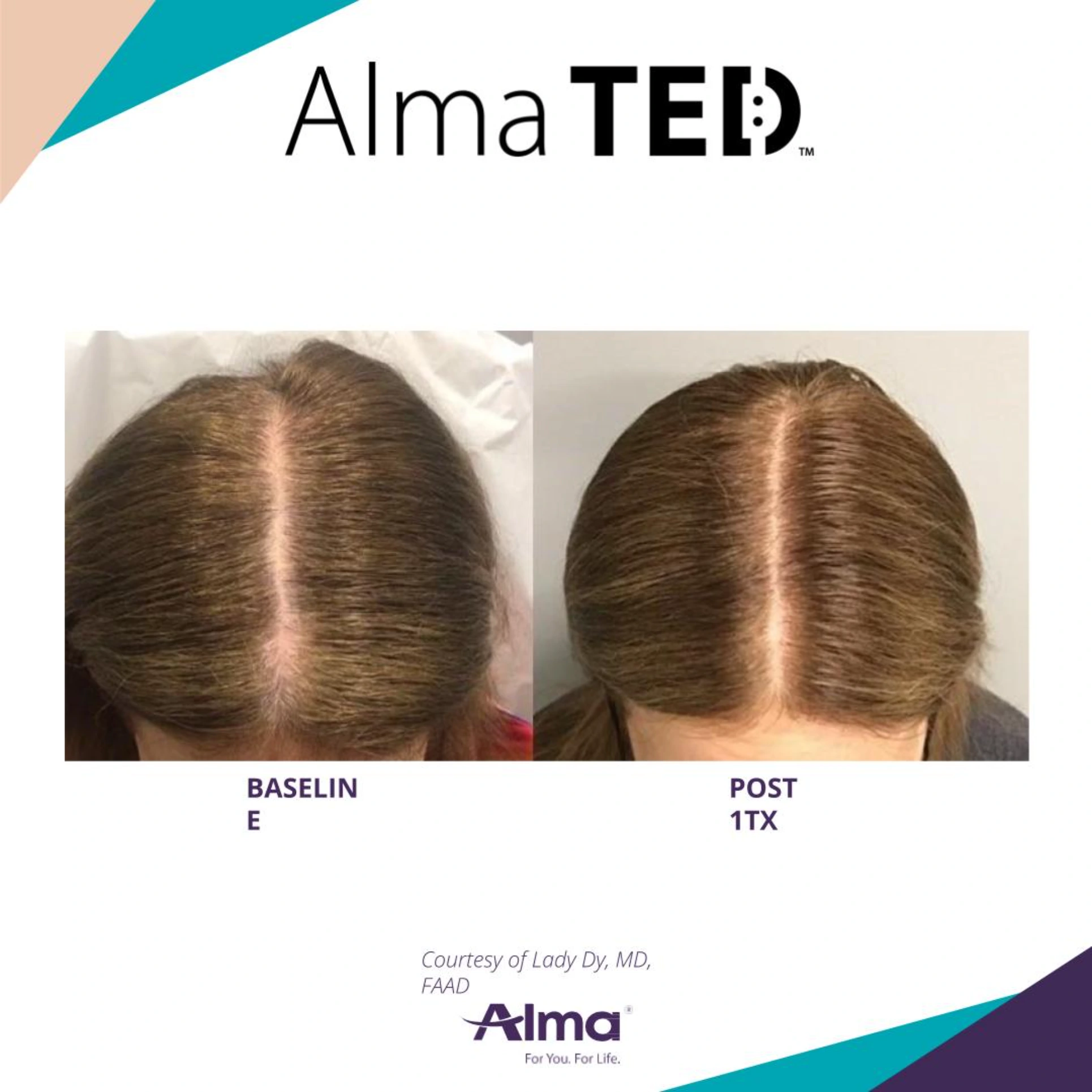 Hair Restoration Park City