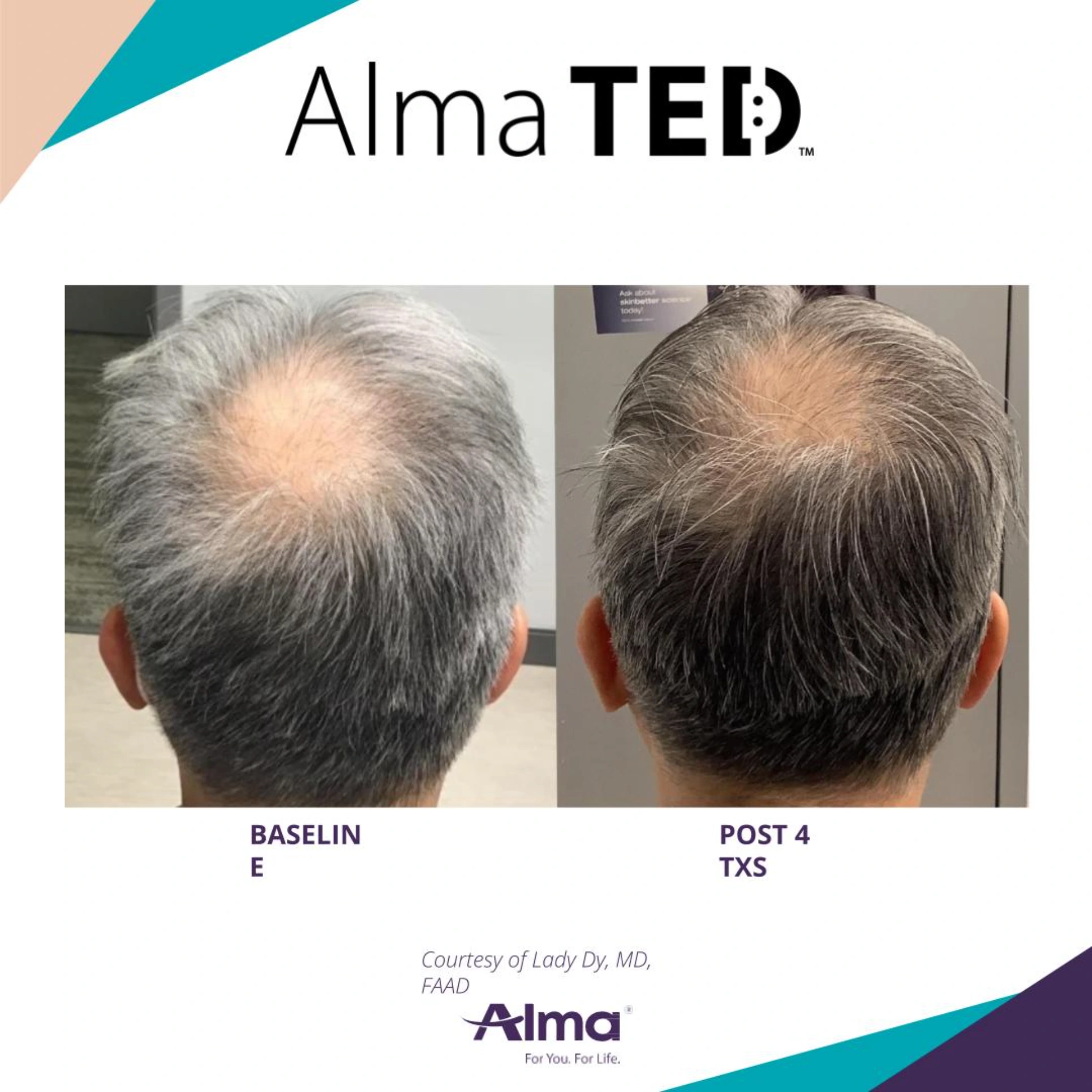 Hair Restoration Park City