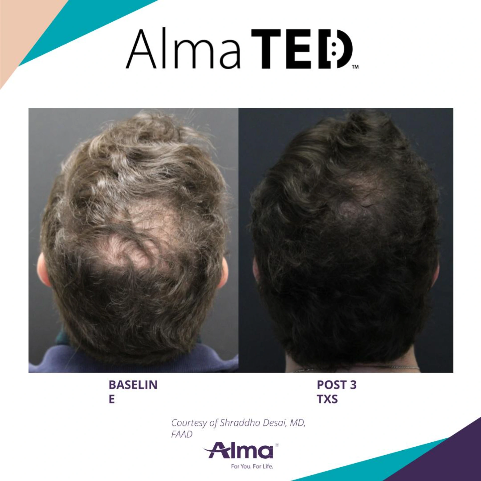 Hair Restoration Park City