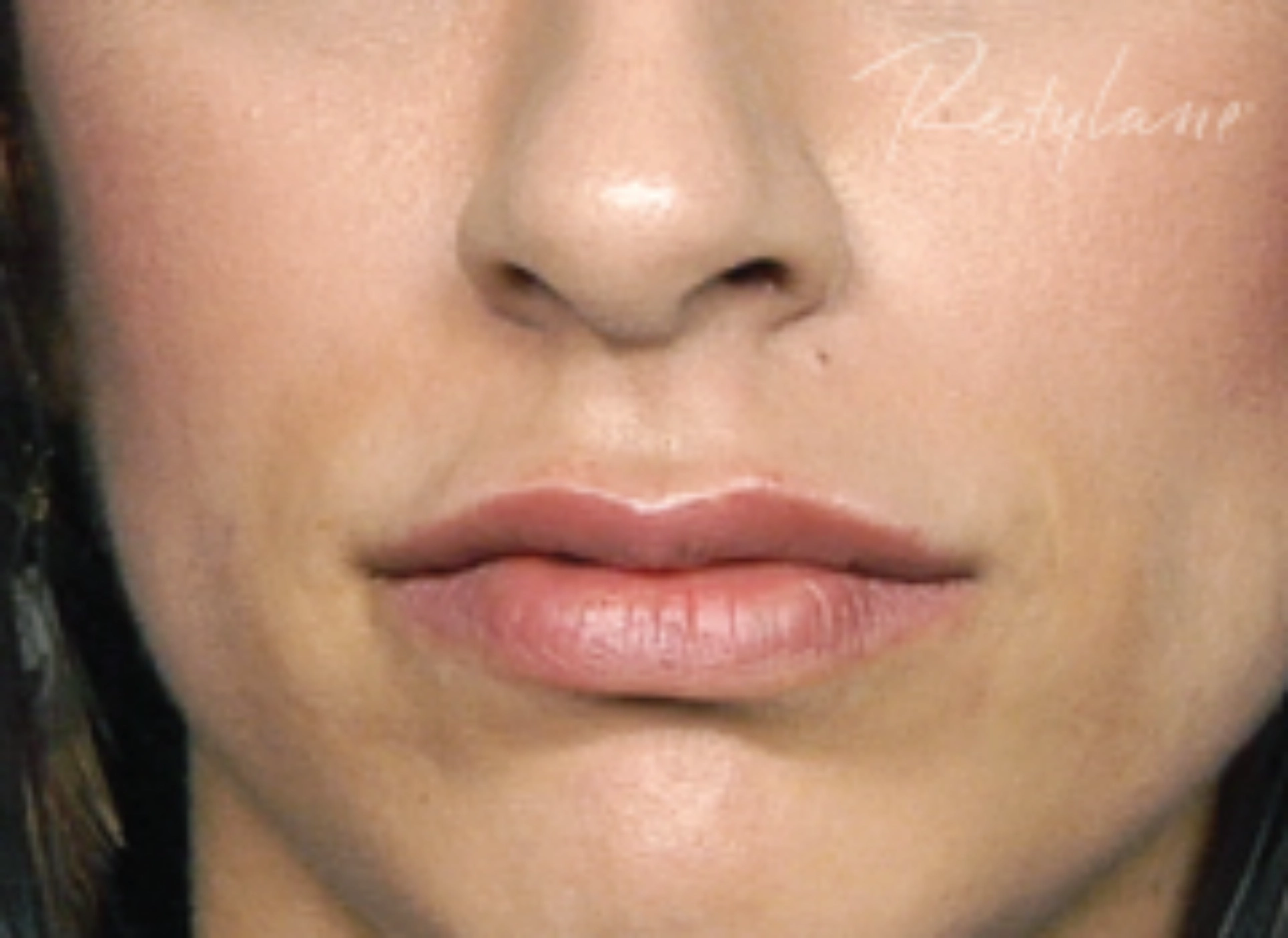 restylane